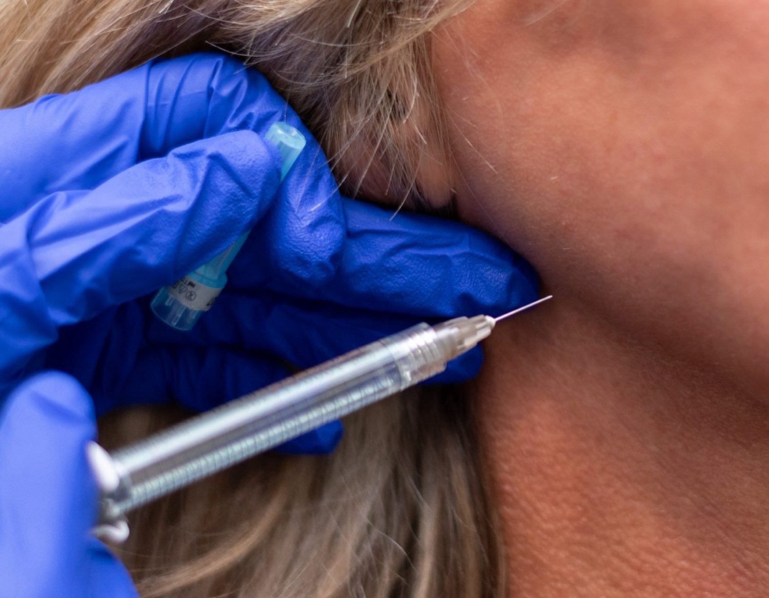 A gloved Belle Vie injector places a fine needle along a patient's jawline during a neurotoxin treatment.